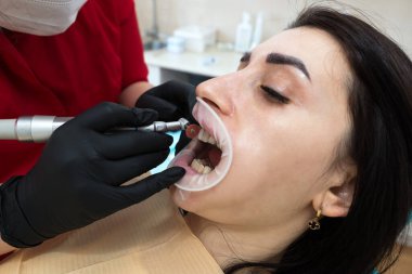 Diş hekimi hastaya diş kaplaması yapar. Kurulum süreci. Diş hekimliği, gülümseme tasarımı, beyaz dişler. Dişlerin restorasyonu..