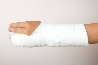 Kırık bir kol ve beyaz bir alçı. Alçıyla kırılan parmaklar. Kırık bir çocuğun kolu alçıda