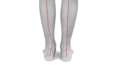 Feet of a boy with flat feet or a dropped arch, the ankle is tilted inward. The red line shows abnormal forms of flat feet compared to the norm. Hallux valgus.Black and white photo. clipart