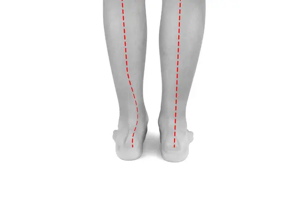 stock image Feet of a boy with flat feet or a dropped arch, the ankle is tilted inward. The red line shows abnormal forms of flat feet compared to the norm. Hallux valgus.Black and white photo.