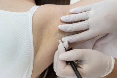 Kuaförde kadın koltukaltı elektrolizi.