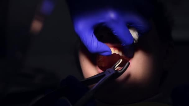 ステンレス鋼歯の力抽出を使用して歯の抽出のクローズアップ手順 小児歯科医の外科医は 永久歯のさらなる噴火のために赤ちゃんの歯を引き出します — ストック動画