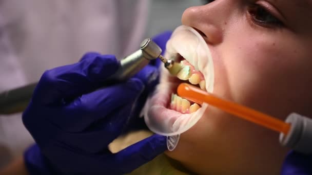 口の中でリトラクターとクロップドビューの子供の少年は 歯科歯磨き粉でハンドピース研磨ブラシでプロの歯のクリーニングを発信 医者歯科衛生士は唾液排出器を使って水を収集します — ストック動画