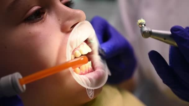 Вид Сбоку Деталь Врач Стоматолог Делает Профессиональную Чистку Зубных Бляшек — стоковое видео
