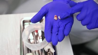 Close-up hands in blue surgical gloves of a surgeon dentist, holding extracted molar baby teeth with decay, above a metal tray with used dental stainless steel instruments, retractor and cotton swabs.