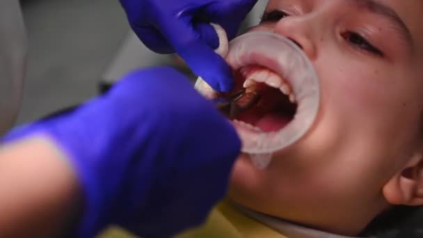 Close Real Procedure Extracting Molar Baby Tooth Interferes Growth Permanent — Video