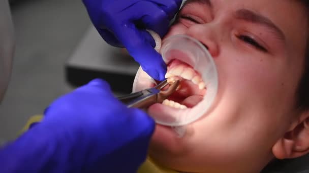 一名牙医医生用不锈钢钳对一名儿童患者进行了极其密切的观察 将一颗磨牙摘除 并将纱布抹在流血的伤口上 — 图库视频影像