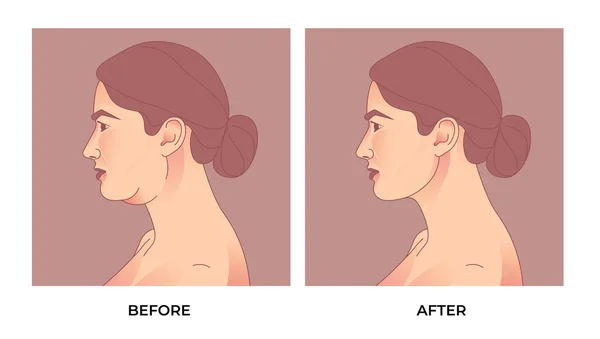 双下巴吸脂术腋窝成形术 抽脂或整形手术 妇女体形改变 体形肥大 — 图库矢量图片