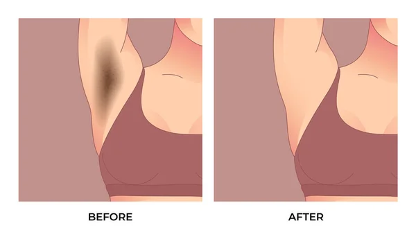 皮肤护理前后的黑色腋下腋窝隆起治疗 — 图库矢量图片