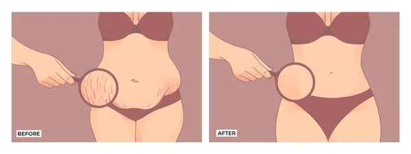 Bauchfett Vor Und Nach Der Gewichtsabnahme Transformation Der Weiblichen Körperform — Stockvektor