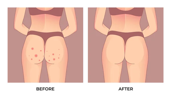 Gesäß Mit Roten Pickeln Vor Und Nach Der Hautbehandlung — Stockvektor