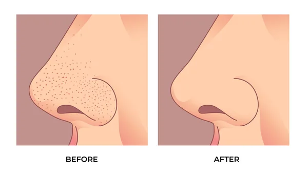 Nase Mit Mitessern Vergrößerte Poren Gesicht Akne Behandlung Vorher Und — Stockvektor