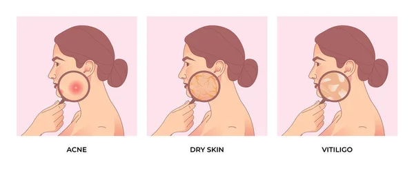 女性はさまざまなタイプの皮膚の問題 にきび 皮膚の毛穴 乾燥した皮膚およびビトリゴに直面しています スキンケアコンセプト — ストックベクタ