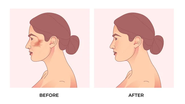 Melasma Sur Visage Femme Traitement Facial Avant Après Pigmentation Mélasma — Image vectorielle