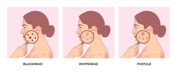 女人面对不同类型的痤疮 皮肤毛孔 黑头发 白头发 痤疮治疗 皮肤护理概念 — 图库矢量图片