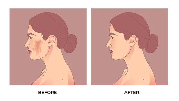 女性の顔にメラスマ メラズマ顔料の顔面処理の前後に — ストックベクタ
