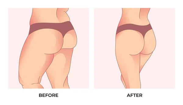 Oberschenkelfett Vor Und Nach Der Gewichtsabnahme Transformation Der Weiblichen Körperform — Stockvektor