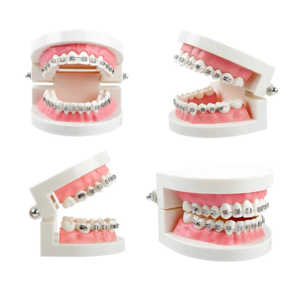 Zestaw Modeli Zębów Metalowymi Drucianymi Aparatami Dentystycznymi Lub Przyrządami Stomatologicznymi — Zdjęcie stockowe
