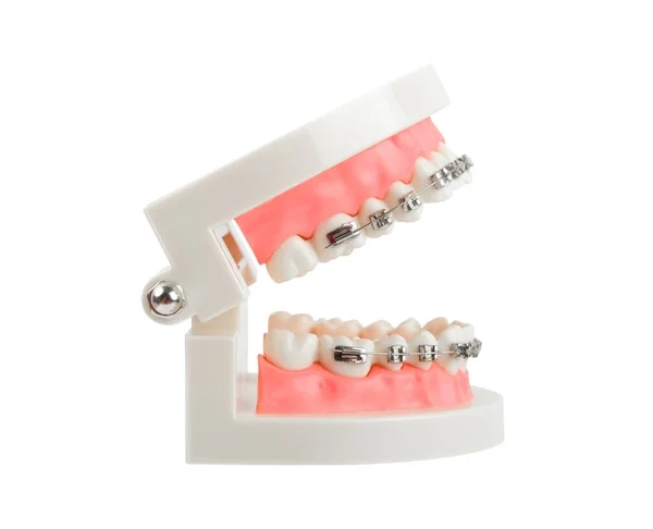 白い背景に金属線歯科用ブレースや歯科用器具で歯モデル クリッピングパスを保存 — ストック写真