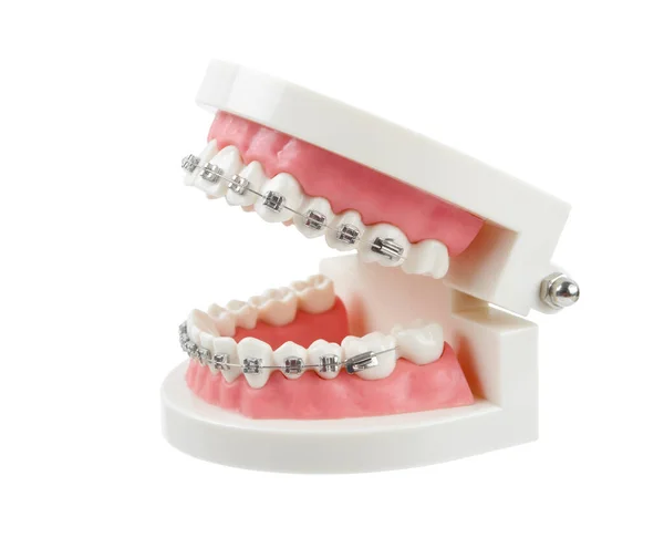 Modelo Dientes Con Abrazaderas Dentales Alambre Metálico Instrumentos Dentales Aislados — Foto de Stock