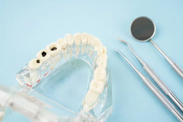 Modelo Dientes Sanos Deteriorados Espejo Bucal Conceptos Dentales —  Fotos de Stock