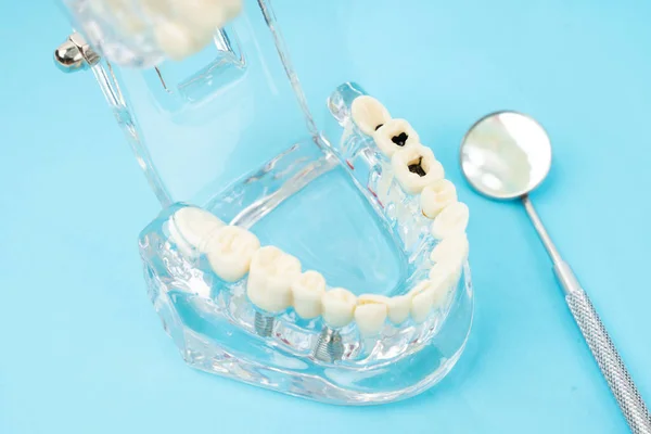 Healthy and decayed teeth model and mouth mirror, Dental concepts.