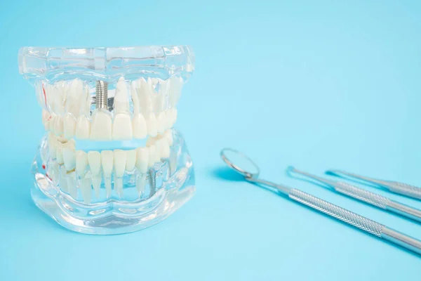 Modelo Prótesis Dentales Mandíbula Acrílico Humano Con Implantes Herramientas Dentales — Foto de Stock