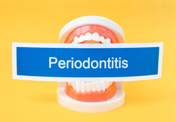 Modelo Dientes Con Enfermedad Dental Periodontitis Sobre Fondo Amarillo — Foto de Stock