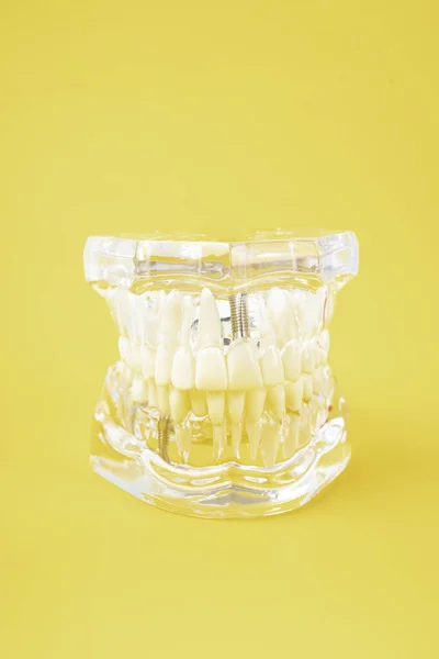 Menselijke Kaak Acryl Kunstgebit Model Met Implantaten Gele Achtergrond — Stockfoto