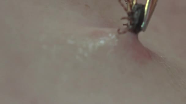 Ziekenhuis Tick Probeert Medische Pincet Uit Menselijke Huid Trekken Insect — Stockvideo