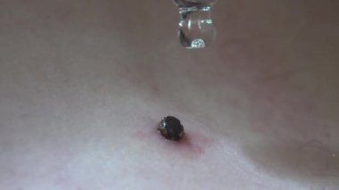 İnsan derisinde bulunan orman kenesi üzerine yağ damlaları