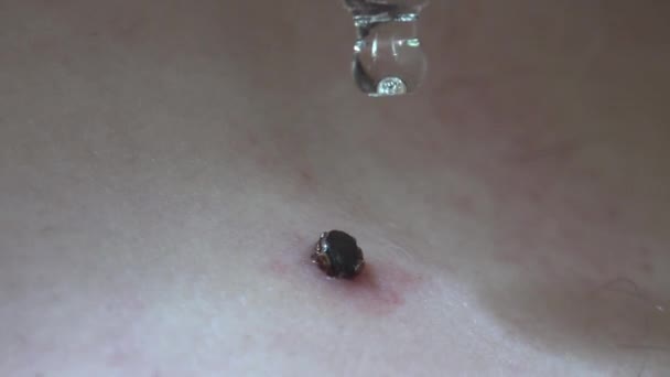 Drops Oil Forest Tick Sits Human Skin — Stock Video