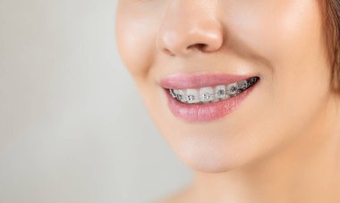 Diş tellerine yakın metal bileklikler. Ortodontik diş hekimi. Sağlıklı Kadın Gülümsemesi. Diş telleriyle gülümseyen kadın. Diş telleriyle beyaz dişleri kapatın. Diş bakımı ve tedavi. Aksesuarlı kız gülüşü.