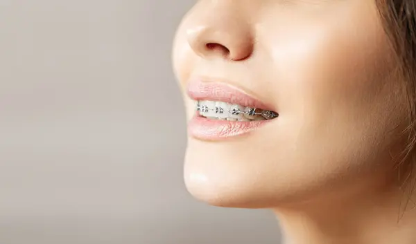 Металлические Скобки Крупным Планом Зубах Ортодонтический Стоматолог Женщина Здоровая Улыбка Стоковая Картинка