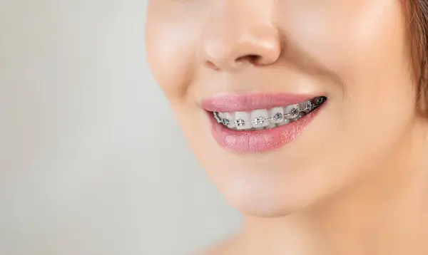Zbliżenie Metalowe Wsporniki Zębach Stomatologia Ortodontyczna Zdrowy Uśmiech Kobiety Uśmiech Zdjęcie Stockowe