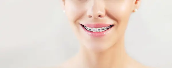 Металлические Скобки Крупным Планом Зубах Ортодонтический Стоматолог Женщина Здоровая Улыбка Стоковое Изображение