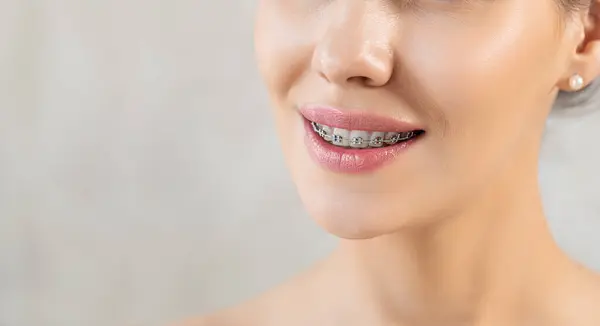 Металлические Скобки Крупным Планом Зубах Ортодонтический Стоматолог Женщина Здоровая Улыбка Лицензионные Стоковые Фото