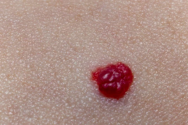 Κόκκινη Ελιά Στο Δέρμα Ακραία Κοντινή Προβολή Μακροεντολή — Φωτογραφία Αρχείου