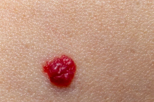 Red Mole Skin Extreme Close View Macro — Stock Photo, Image