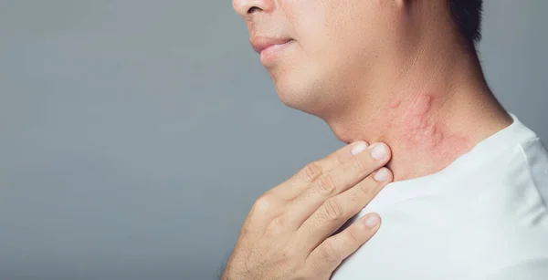 Закрыть Человека Красными Папулами Зудящей Сыпью Царапающей Шею Симптомы Аллергии — стоковое фото