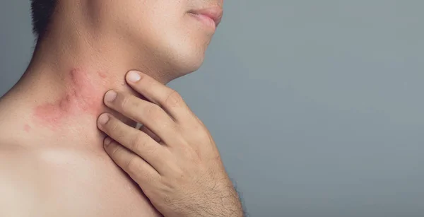 Close Man Having Red Papules Itchy Rash Scratching His Neck — Stock Photo, Image