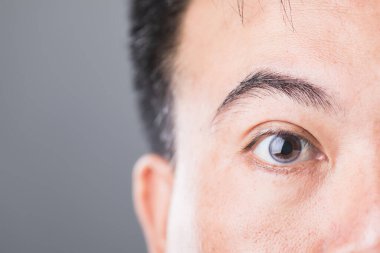 Diyabetik bir hastanın gözünün yakın çekimi, diyabetik retinopati ve maküler dejenerasyonun risklerini sembolize ediyor. Diyabetle ilgili komplikasyonlar için göz sağlığı ve izlemenin önemini vurgular
