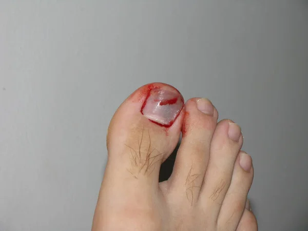 The big toe nail after being hit by a skateboard. A small amount of blood and immediant formation of a hematoma.