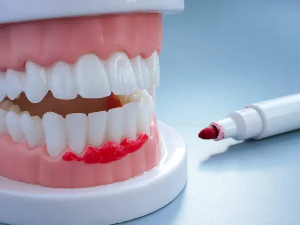 Dental Plastic Jaw Marked Marker Gum Disease Concept Stock Picture