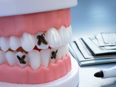 Diş tedavisi ve sigorta. Plastik sahte çene ve para.