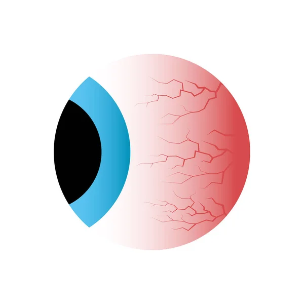 Красный Глаз Нездоровый Стресс Бессонница Капилляры Зрачки — стоковый вектор
