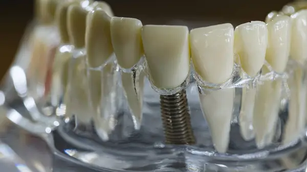 Implante Dentário Raízes Dentárias Artificiais Mandíbula Canal Radicular Tratamento Dentário — Fotografia de Stock