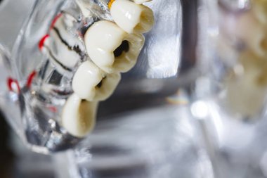 Diş bakımı, ağız bakımı konsepti. Diş modelinde bakımı, yirmilik dişi gibi yaygın diş hastalıkları görülür. Ağız sağlığı. Uzayı kopyala Diş sağlığı sorunları