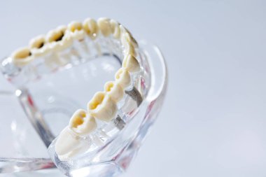 Diş bakımı, ağız bakımı konsepti. Diş modelinde bakımı, yirmilik dişi gibi yaygın diş hastalıkları görülür. Ağız sağlığı. Uzayı kopyala Diş sağlığı sorunları