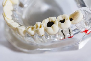 Diş bakımı, ağız bakımı konsepti. Diş modelinde bakımı, yirmilik dişi gibi yaygın diş hastalıkları görülür. Ağız sağlığı. Uzayı kopyala Diş sağlığı sorunları